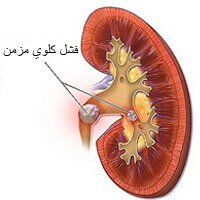 تأثير السكري على الكلى